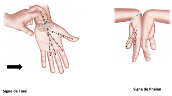 Examen clinique du poignet avec les tests orthopédiques de Phalen et de Tinel pour détecter le canal carpien.