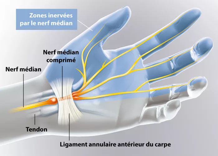 Schéma anatomique du canal carpien montrant le nerf médian comprimé sous le ligament transverse du poignet.