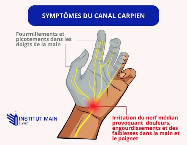 Dessin anatomique des zones d'engourdissement de la main (pouce, index, majeur) causées par la compression du nerf médian.