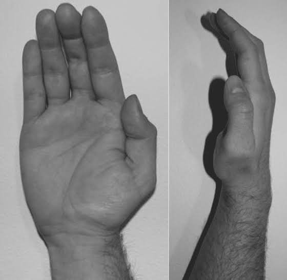 Atrophie musculaire de la base du pouce ou éminence thénar, signe clinique d'un syndrome du canal carpien sévère.
