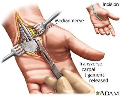 Illustration médicale de la chirurgie du canal carpien avec la section du ligament pour libérer le nerf médian.