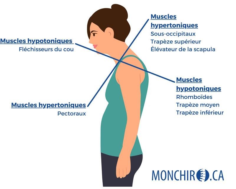 L&rsquo;Upper Cross Syndrome, c&rsquo;est quoi ?