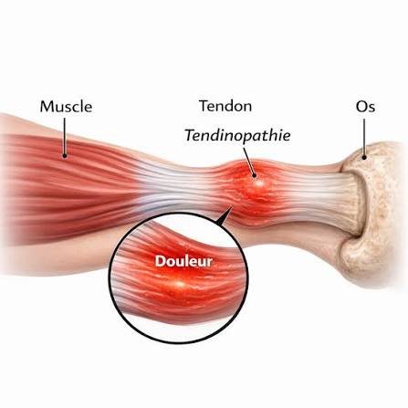 Une tendinopathie c&rsquo;est quoi ?