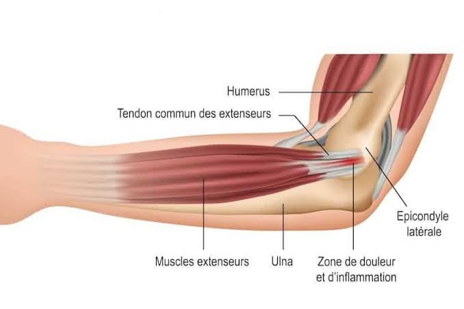 Le cas des épicondyliens (tennis elbow)